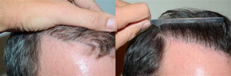 Patient Foundation For Hair Restoration