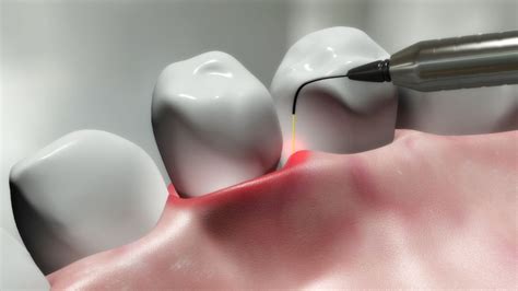 Laser Treatment For Gum Disease Dental Wellness Group