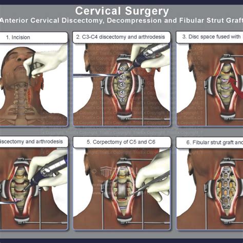 Cervical Surgery Trialexhibits Inc