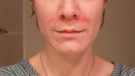 Face Skin Rashes Identification Images And Photos Finder