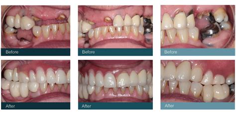Flexible Dentures In Glasgow Tiwari Watson Dental Care