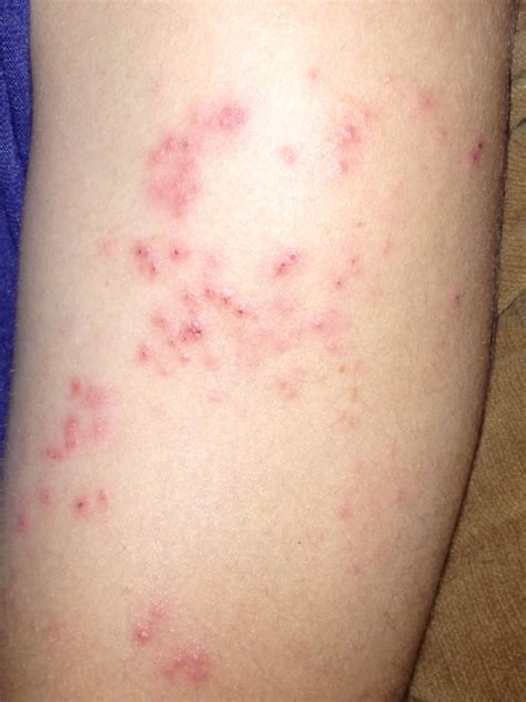 My Son Has A Non Itchy Rash That Is Warm To The Touch On His