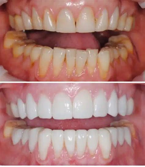 veneers before and after results