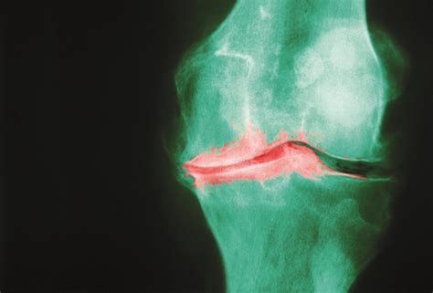 Pathophysiology Of Knee Osteoarthritis