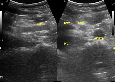 Acute Superior Mesenteric Artery Occlusion On Ultrasound Radiology