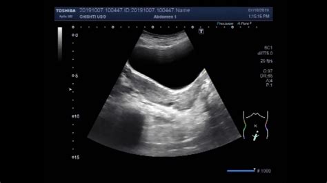 Ultrasound Video Showing A Case Of Uterus Didelphys Youtube
