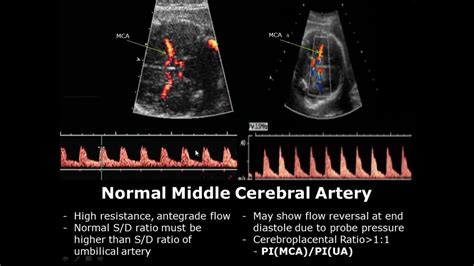 Fetal Middle Cerebral Artery Doppler Ultrasound Normal Vs Abnormal Image Appearances Mca Usg