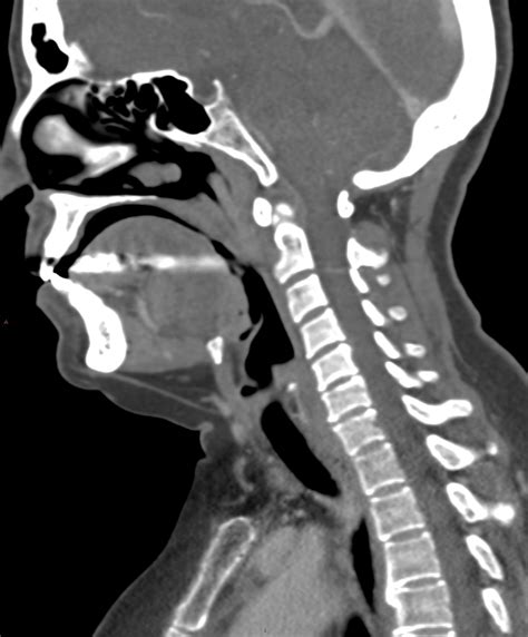 Normal CT Neck Image Radiopaedia Org