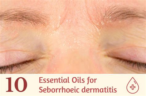 10 Essential Oils For Seborrheic Dermatitis Essential Oil Benefits