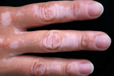 Vitiligo Symptoms Causes Treatment And Photos