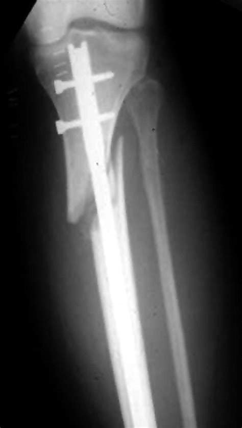 Proximal Tibia Fractures And Intramedullary Nailing The Impact Of Nail