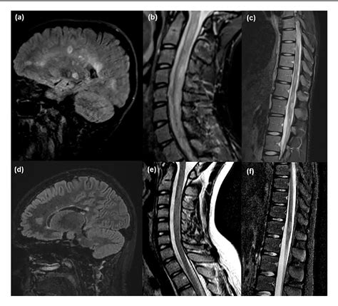 figure 1 from pediatric ms patients with a primary progressive like disease may still have