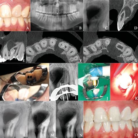 Treatment Of Tooth 10 A Preoperative Photograph B Preoperative