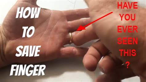 Never Cut Off Finger Or Ring And This Is Why Youtube