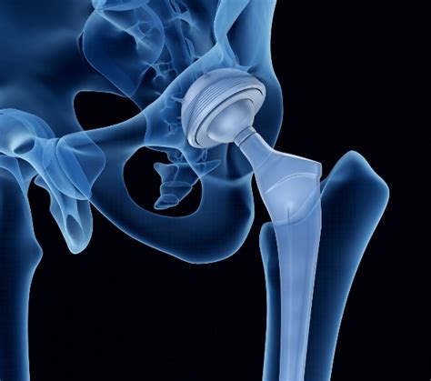 Case Study Total Hip Replacement Aqua Physio