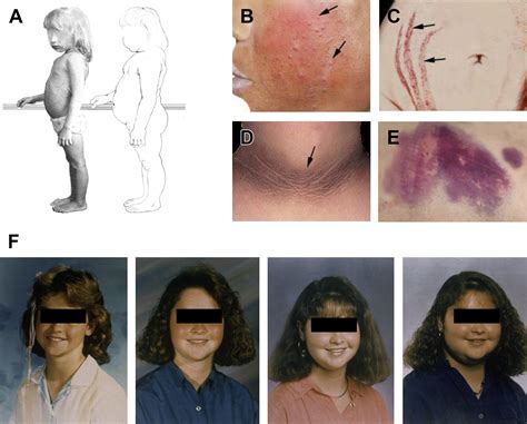 Diagnosis And Clinical Genetics Of Cushing Syndrome In Pediatrics