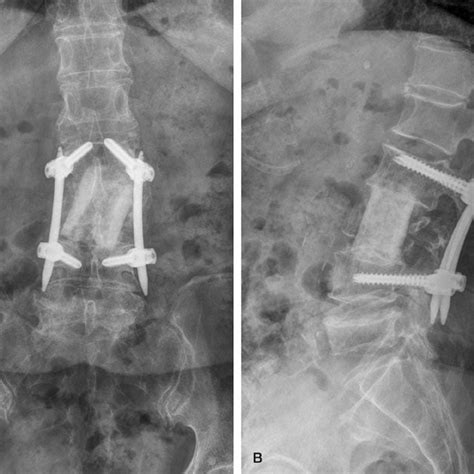 A Ap And B Lateral Radiographs Which Were Taken After 2 Years Of