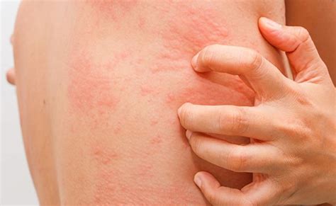 Urticaria Causes Symptoms And Treatment Otosection