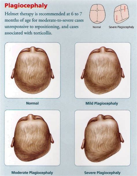 Understanding Flat Head Syndrome Positional Plagiocephaly Dixon Verse