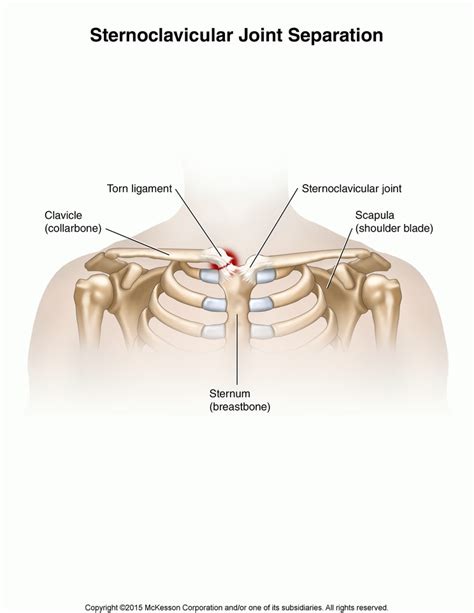 Sternoclavicular Joint Separation Tufts Medical Center Community Care
