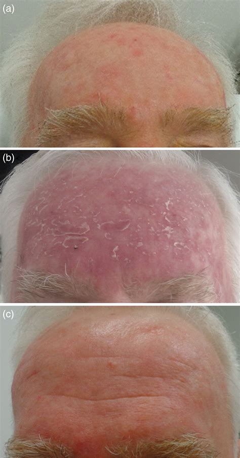 Pdf Photodynamic Therapy For Actinic Keratosis Of The Forehead And My