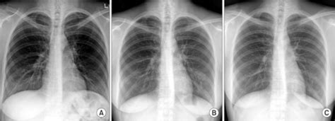 A Initial Chest X Ray Shows No Definite Abnormalities