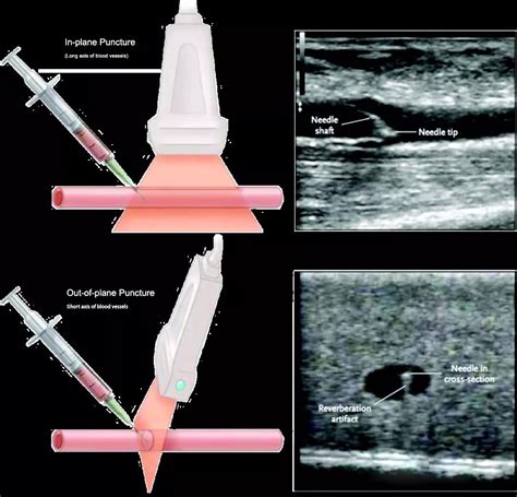 News Manifestation And Concealment Of Puncture Needle Under Ultrasound