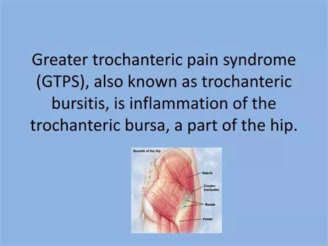 PPT Greater Trochanteric Pain Syndrome GTPS Also Known As Trochanteric Bursitis Is
