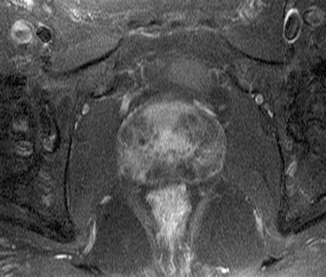 Conventional Mri Capabilities In The Diagnosis Of Prostate Cancer In