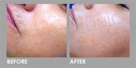 Mesotherapy For Large Pores Tightening Treatment Premier Clinic