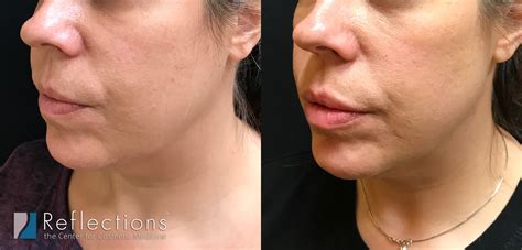 Lip Filler Chin Filler And Filler In Marionette Lines To Remove Jowls