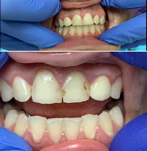 Front Teeth Fillings Before And After