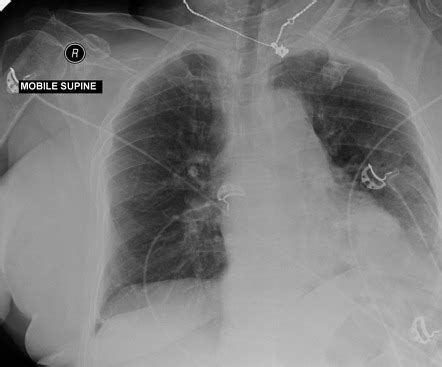 Diaphragmatic Rupture Radiology Reference Article Radiopaedia Org