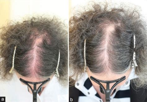 A And B Red Scalp Syndrome Before And After 6 Months Open I
