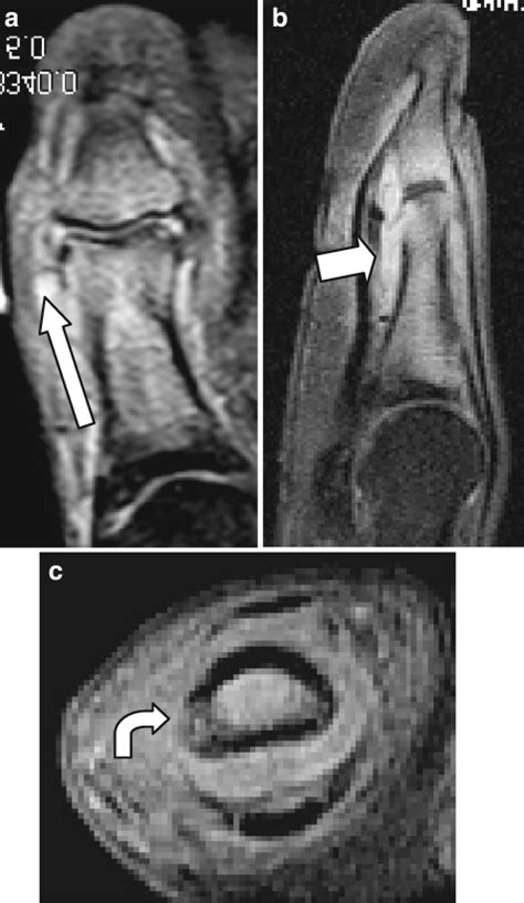 A Coronal Long Axis Proton Density Fat Suppressed And B Sagittal And C Download Scientific