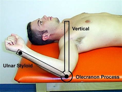 It is caused by an external blow to the there is an indirect force applied to the humerus that combines flexion, adduction, and internal rotation. Goniometry