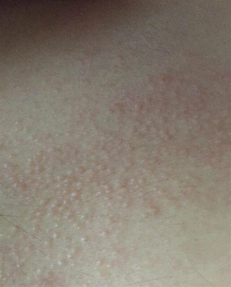 Itchy Bumps On Chest Abdomen Back Of Neck And Lower Back Someone