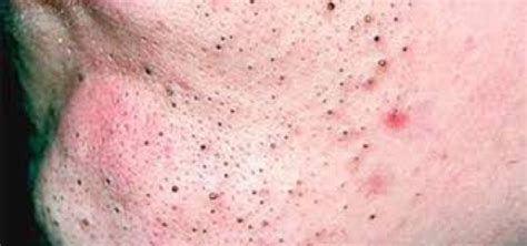 4 Common Skin Conditions Blackheads Whiteheads Congestion And Cystic