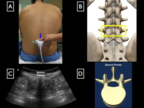 Lumbar Puncture Highland Em Ultrasound Fueled Pain Management