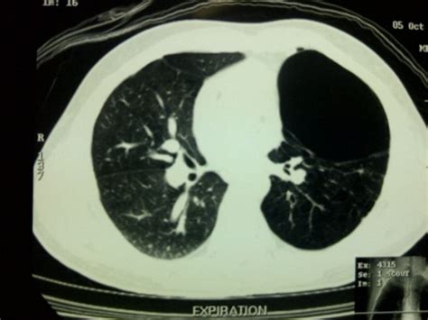 39 Bullous Disease Of The Left Lung On Ct Scan 40 Large Bulla Being
