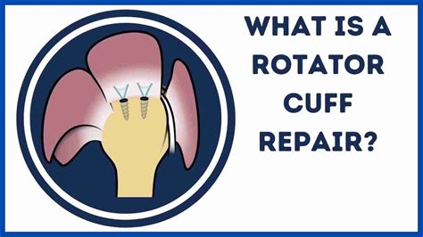 What Is A Rotator Cuff Repair Youtube