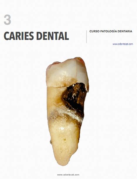 Odontocat Curso Online De Patología Dentaria
