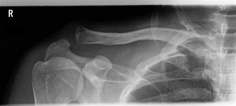 Acromioclavicular Joint Injury Type Ii Image Radiopaedia Org My Xxx