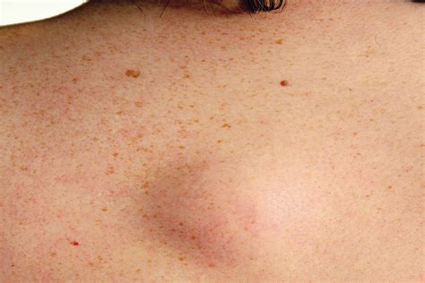 Images Of Skin Cancer On Your Back Cancerwalls