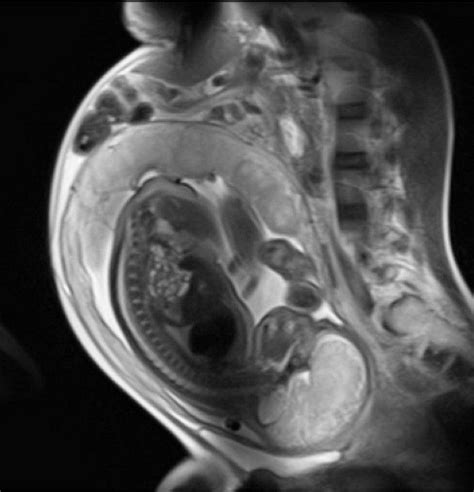 Imagén Por Resonancia Magnética De Una Mujer Embarazada Presentación
