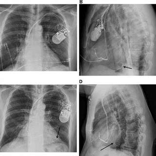 Posteroanterior A And Lateral B Chest X Rays Demonstrating The ICD