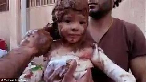 Syrians Foreced To Use Wet Mud To Treat A Little Girls Napalm Burns