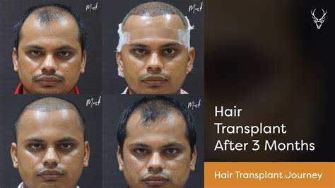 Hair Transplant Journey Hair Transplant After 3 Months Results