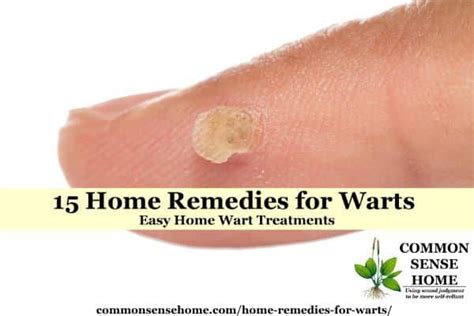 15 Home Remedies For Warts Easy Home Wart Treatments Home Remedies
