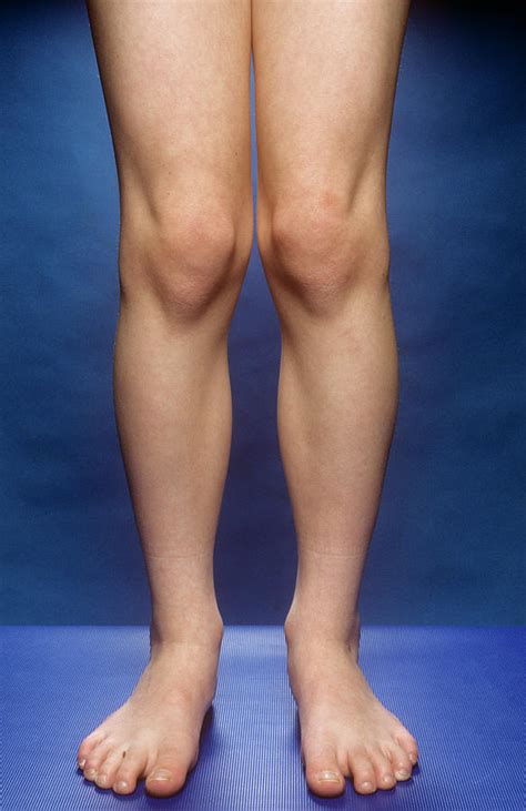 Knock Knees Photograph By Mike Devlinscience Photo Library Fine Art